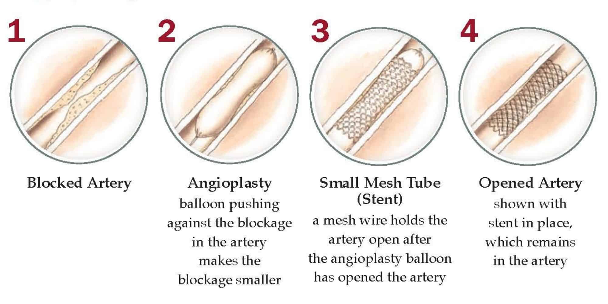 Angioplasty and Stent