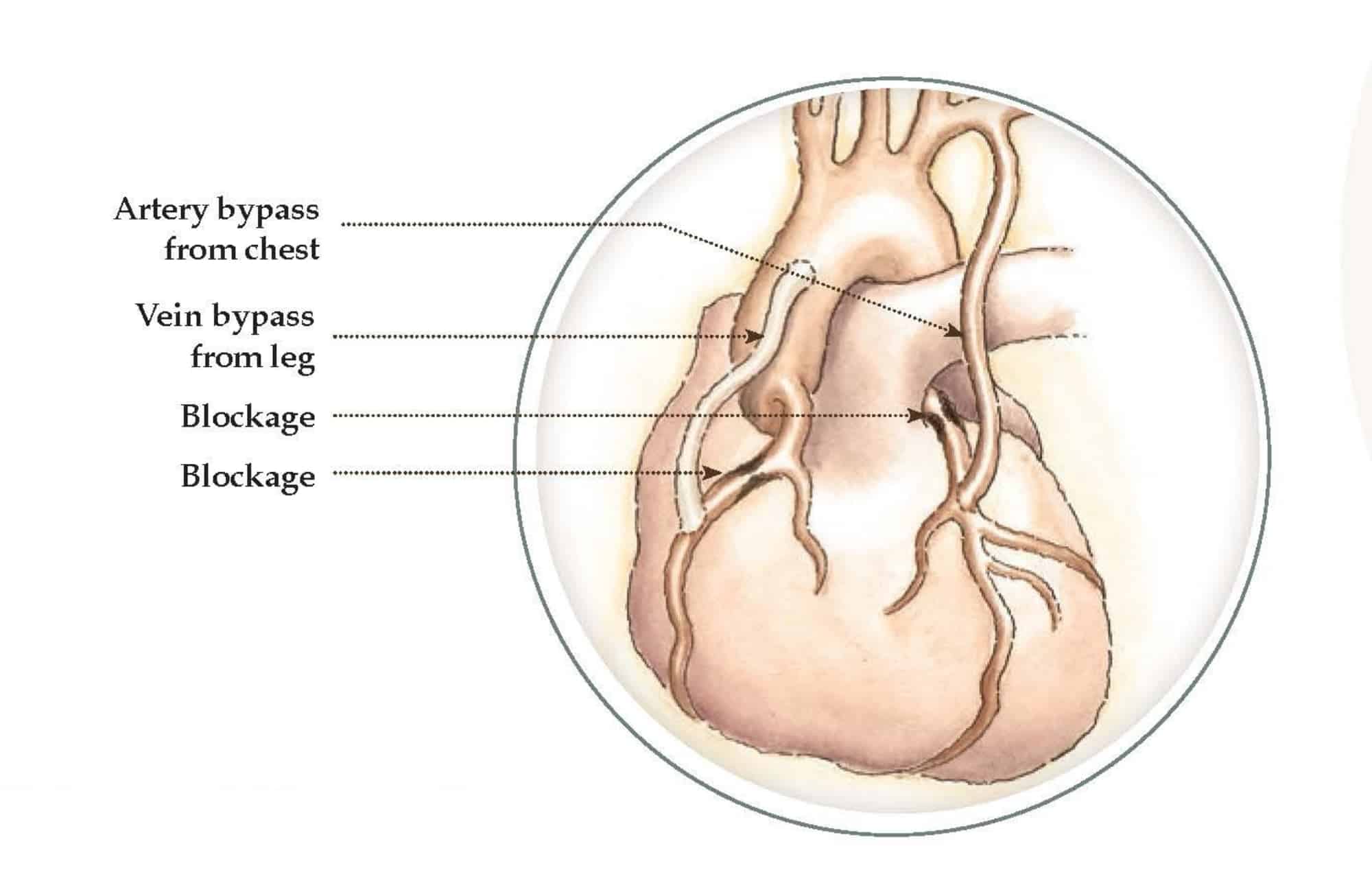 Heart Bypass Surgery