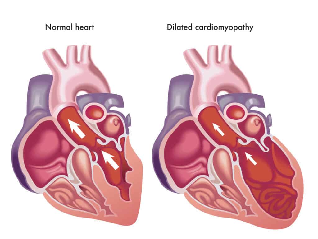 heart with dilated cardiomyopathy