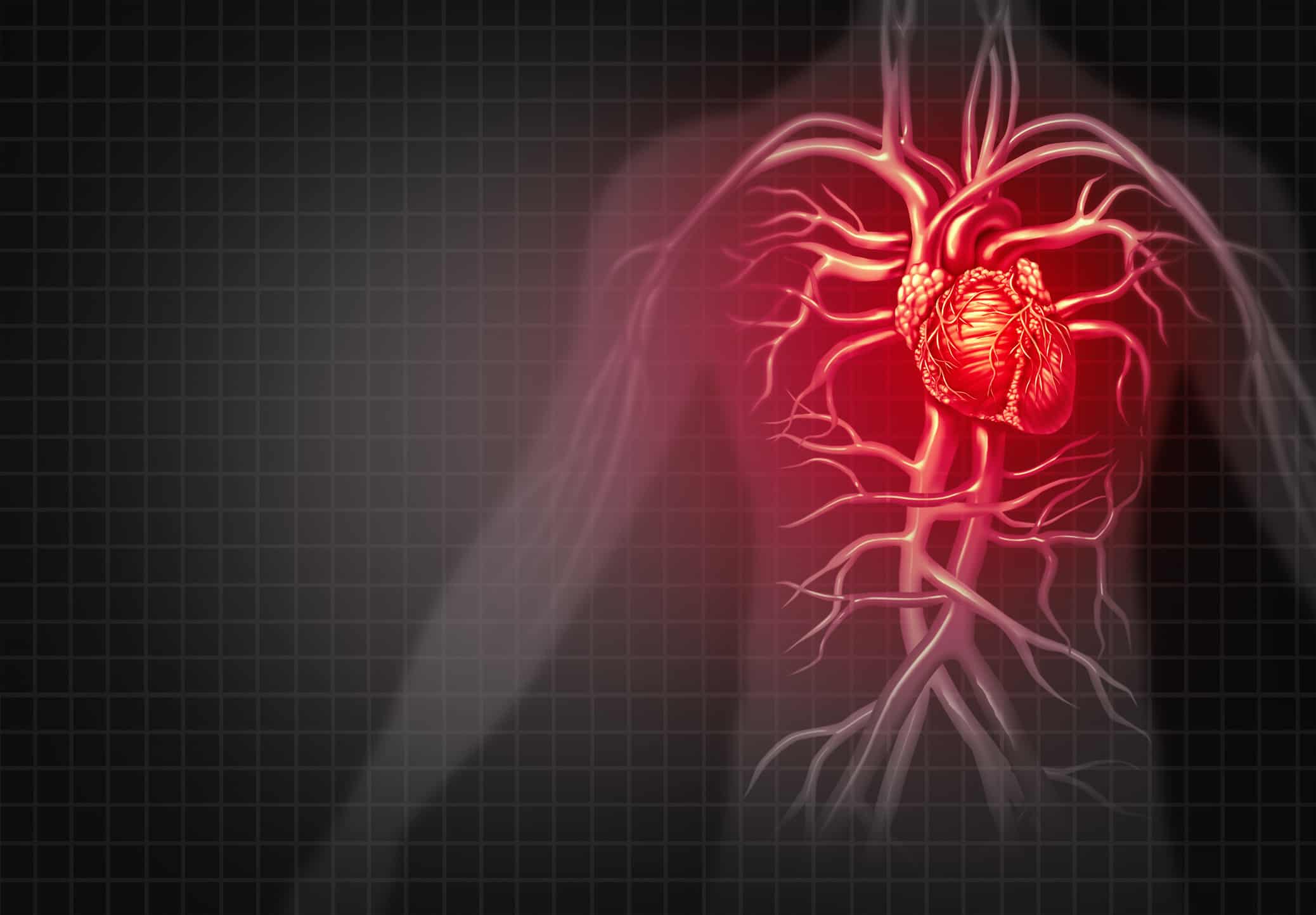 Heart Attack Heart attack and chest pain medical cardiovascular disease as an illness of a human circulation organ in a 3D illustration style.