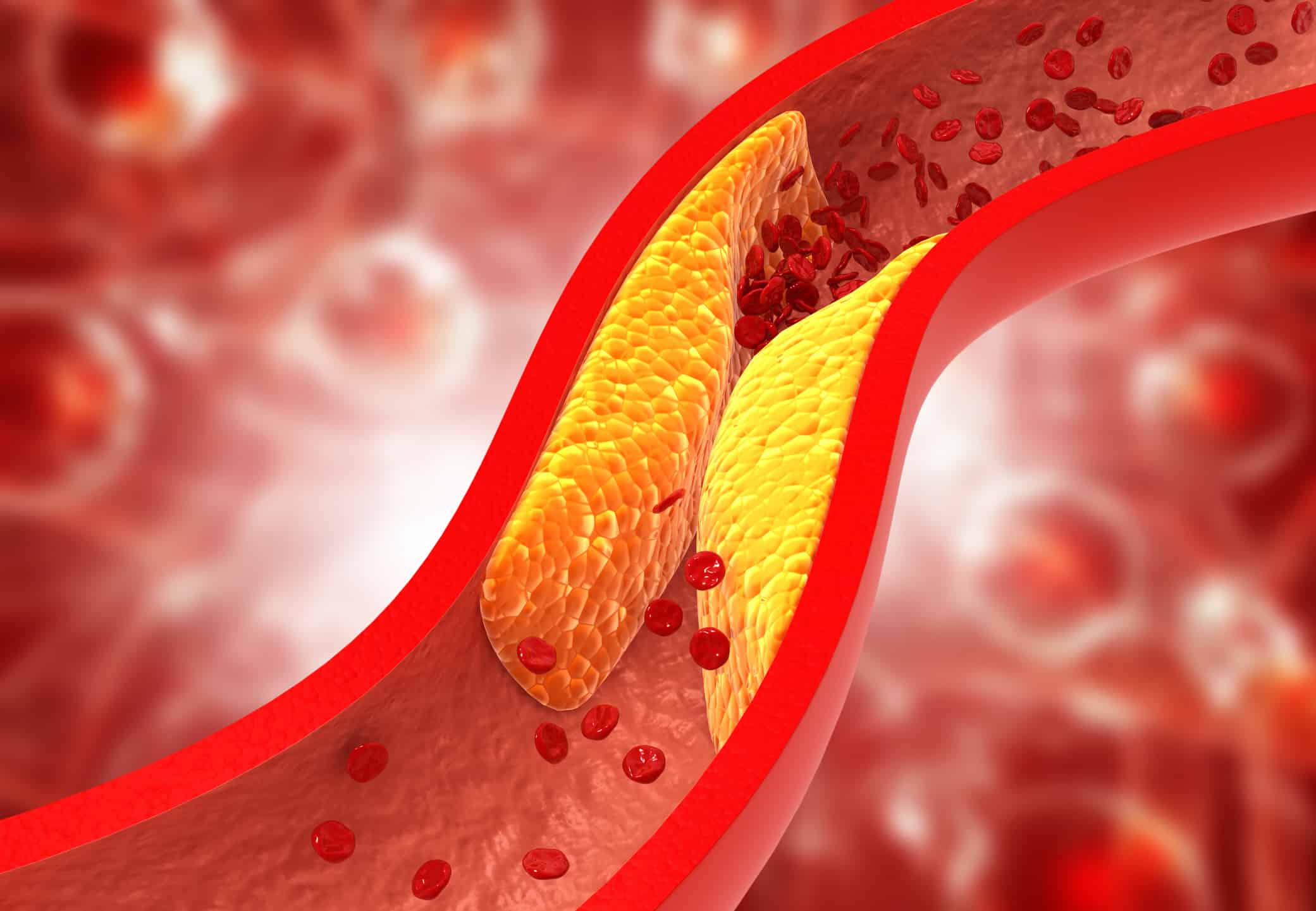 Clogged arteries, Cholesterol plaque in artery Clogged arteries, Cholesterol plaque in artery. 3d illustration