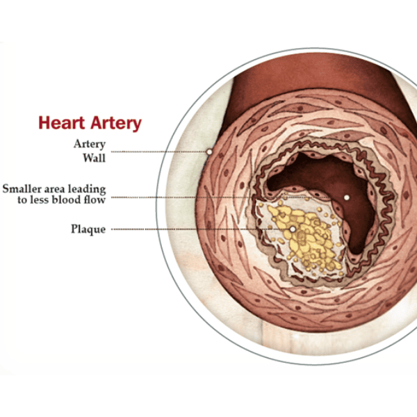 Basics of Angina (1) Basics of Angina (1)