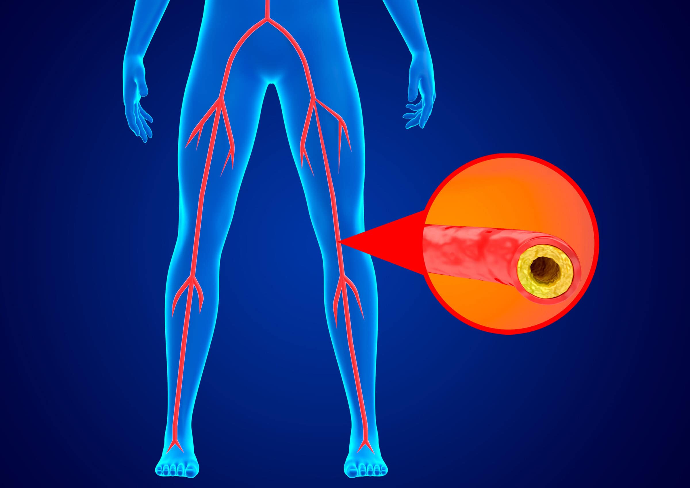 Peripheral arterial disease is the accumulation of fat and calcium in the walls of the arteries of the lower limbs preventing blood flow. 3D illustration