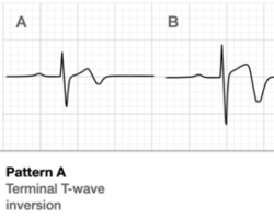 Wellens Syndrome EKG 200x250