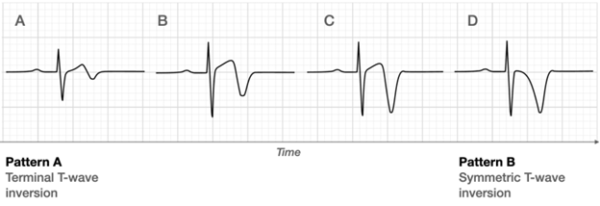  Ecgweekly.com. Wellens’ Pattern A and B